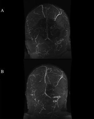 Brain MRI angiography revealing extensive venous thrombosis affecting the superior longitudinal, transverse, and sigmoid sinuses of both hemispheres (A). One-month follow-up image (B) showing partial recanalisation of the left superior longitudinal, transverse, and sigmoid sinuses after treatment with dabigatran.