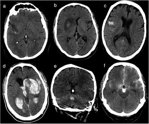 Baseline head CT scan performed within 36hours of revascularisation. (a) Haemorrhagic infarction type 1: small petechiae around the infarcted area. (b) Haemorrhagic infarction type 2: confluent petechiae in the infarcted area with no mass effect. (c) Parenchymal haematoma type 1: haematoma in ≤ 30% of the infarcted area, with no mass effect. (d) Parenchymal haematoma type 2: parenchymal haematoma open to the ventricular system, observed in > 30% of the infarcted area, with a significant mass effect. (e) Remote parenchymal haematoma type 1: small haemorrhage with no association with the infarcted area (left middle cerebral artery territory). (f) Haemorrhagic infarction type 1+subarachnoid haemorrhage+contrast uptake: small petechiae around the infarcted area, haematoma in the subarachnoid space, and contrast uptake.