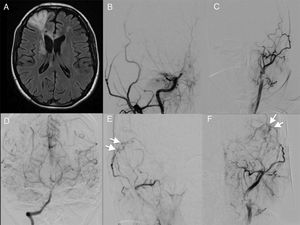 Representative case 2. Patient with bilateral moyamoya disease who underwent bilateral revascularisation. A) An MRI study revealed ischaemia in the right frontal lobe. B and C) An angiography study showed bilateral internal carotid artery occlusion (Suzuki stage 4). D) Contrast administration to the vertebral artery revealed collateral circulation through the posterior communicating arteries. E and F) Angiography study with contrast administration to the right external carotid artery, showing the site of anastomosis of the superficial temporal artery to the middle cerebral artery, with good flow (arrows; see video in Supplementary Material).