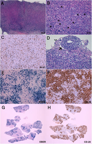 Brain biopsy. A-B) Haematoxylin-eosin staining showed intense polymorphous inflammatory infiltrate containing lymphocytes, plasma cells, and histiocytes, intermingled with large, atypical cells (B, arrows), some of which were close to blood vessels (B, arrowheads). C) The Ki67 proliferation index was > 40%. These cells tend to form aggregates of >50 cells (B) and present an angiocentric and angiodestructive growth pattern (D). Immunohistochemical studies (E, F, G, H) revealed that these atypical cells express CD20 (present in B-cells) and EBER (Epstein-Barr virus–encoded RNA, which indicates Epstein-Barr virus infection). A comparison of histology sections revealed a nearly complete overlap between EBER-expressing and CD20-expressing cells (G, H). All these findings are diagnostic of an EBV-associated B-cell lymphoproliferative disorder, compatible with lymphomatoid granulomatosis grade 3.