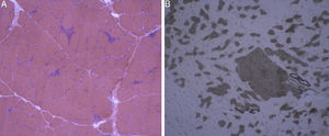 Haematoxylin-eosin staining and immunohistochemical study of a muscle specimen. A) Haematoxylin-eosin staining: skeletal muscle with normal architecture, without thickening of endomysial connective tissue or adipose tissue infiltration. The image shows fibre regeneration, as well as fibre necrosis, with signs of myophagocytosis. B) ATPase pH 9.4 stain: rearrangement by fibre type, with groups of type 1 and type 2 fibres, a finding suggestive of reinnervation.