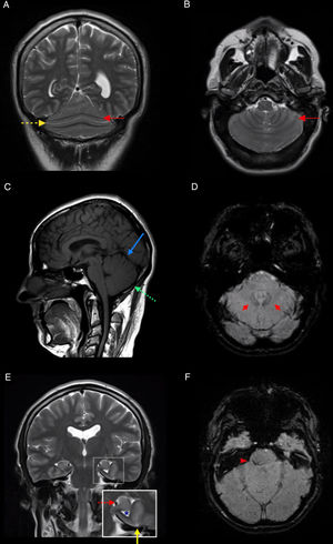 MRI study of our patient. A and B) Coronal and axial T2-weighted sequences, showing partial fusion of the cerebellar hemispheres and continuity of the folia (solid red arrow) and fissures (dashed yellow arrow) across the midline. C) Sagittal T1-weighted sequence showing absence of the primary (solid blue arrow) and prepyramidal fissures (dashed green arrow). D) Axial SWI sequence showing proximity of the dentate nuclei to the midline (red arrows). E) Coronal T2-weighted sequence showing left-sided incomplete hippocampal inversion (dashed red arrow), associated with vertical orientation of the collateral sulcus (solid yellow arrow) and dilation of the ipsilateral temporal horn (asterisk). F) Axial SWI sequence showing capillary telangiectasia in the right middle cerebellar peduncle.