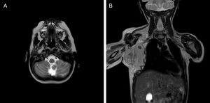 (A) Brain MRI showing lesions compatible with cerebellitis. (B) Chest MRI showing a large bulky mass on the right side.