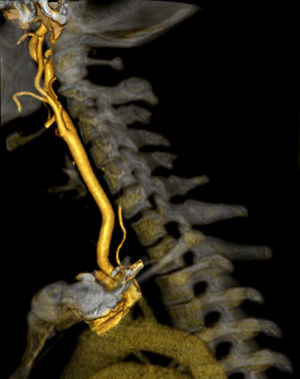 CT angiography reconstruction of the supra-aortic arteries: stenosis of the V2 segment of the left vertebral artery.