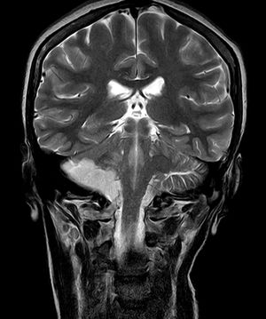 T2-weighted brain MRI sequence: subacute infarction of the right posterior-inferior cerebellar artery.