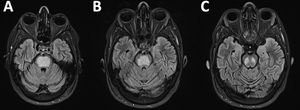 Brain MRI scan, FLAIR sequence. Extensive hyperintensity in the central pontine region, reaching the caudal midbrain, with the peripheral area being preserved (piglet sign); this is compatible with central pontine myelinolysis.