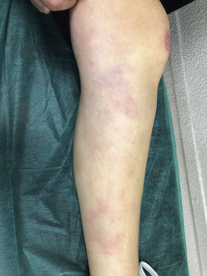 Warm, erythematous nodules on the lower limbs, compatible with erythema nodosum.