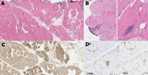 Anatomical pathology study of the right gastrocnemius muscle. (A) Denervation atrophy pattern. Group atrophy. Haematoxylin-eosin stain, 9×. (B) Foci of endomysial inflammatory infiltrate. Haematoxylin-eosin stain, 10×. (C) Fibre type grouping. ATPase pH 9.4 stain, 6×. Macrophages in the endomysium and within fibres. CD3+ lymphocytes in the endomysium and surrounding fibres. Immunohistochemical staining of CD68 and CD3, 10×.