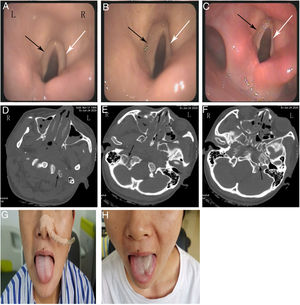 The electronic fiber laryngoscope shows that the bilateral vocal cords were fixed and the glottis could not move on July 23 (A). The left vocal cord (black arrow) was fixed and the right vocal cord (white arrow) was normal on August 21. There was a gap when the bilateral vocal cords closed (B). The left vocal cord (black arrow) was still fixed on September 21 (C). The computed tomography showed that the fracture of the left transverse process of the atlas and right skull base was mild (D, E). Bone fragments were found in the left occiput (F). The tongue tilted to the left on July 30 (G). The muscles of the left tongue were atrophy, and the tongue deviated to the left side on September 21 (H).