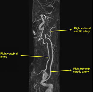 MRI angiography of the supra-aortic trunks.