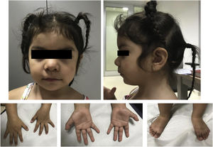 Phenotype of our patient at the age of 3 years. Coarse facial features, mild hypertelorism, arched eyebrows with mild synophrys, low nasal bridge, short nose, anteverted nares, thin upper lip with downward oral commissures, mild retrognathia, mild brachydactyly, and surgically corrected postaxial polydactyly in both feet.