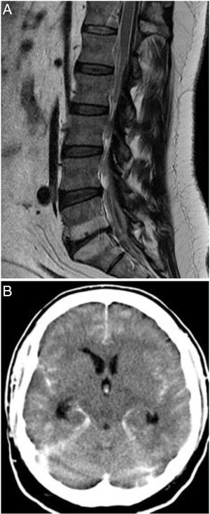 A) T1-weighted MRI study of the spine (sagittal plane), showing epidural haemorrhage of the thoracolumbar spine. Loculi with greater posterior blood pooling are observed at the T12-L1 and S1-S2 levels. The morphology of the spinal cord is normal. B) Non-contrast head CT scan showing perimesencephalic, intraventricular, and cerebellar subarachnoid haemorrhage (Fisher grade IV).