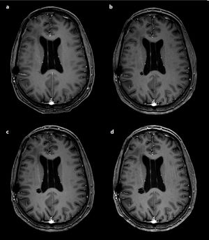 Contrast-enhanced T1-weighted 3D-SPGR MRI studies: follow-up studies performed in 2017, 2018, 2019, and 2020 (images a-d, respectively). The images show progressive growth of a round lesion in the right corona radiata, isointense to CSF and without enhancement.