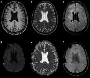Status of the lesion in an MRI study performed in 2020. a) Non-contrast T1-weighted 3D-SPGR sequence; b) T2-weighted TSE sequence; c) 3D T2-FLAIR sequence; d) diffusion sequence (b = 1000); e) ADC map; f) magnetic susceptibility sequence. The lesion is isointense to CSF on T1- and T2-weighted sequences (a, b), and presents signal suppression on T2-FLAIR sequences (c), which suggests free water in the centre and absence of peripheral oedema or gliosis; it also presents facilitated diffusion (d, e). The magnetic susceptibility sequence shows hypointense haemorrhagic foci near the lesion, within the radiation field (f).