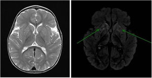 Brain MRI scan: bilateral signal alterations in the putamen and head of the caudate nucleus; hyperintense lesions on T2-weighted (left) and FLAIR sequences (right: arrows). No globus pallidus or internal capsule involvement were observed. No loss of parenchymal volume was observed at the supra- or infratentorial levels.