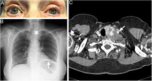 (A) Left ptosis and miosis in semi-darkness. (B) Anteroposterior chest radiography showing elevation of the left hemidiaphragm (arrow) and right-sided tracheal deviation in the superior mediastinum (asterisk). (C) Neck CT scan (axial plane) with intravenous contrast, revealing a mass originating from the left thyroid lobule (asterisk), with irregular density and involving the left common carotid artery (arrow).