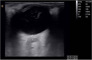 Orbital ultrasound study of the right eye.