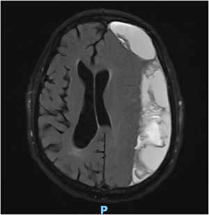 FLAIR MRI study, axial plane.