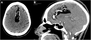 A) Non-contrast head CT scan revealing a hypodense interhemispheric lesion with peripheral calcifications, and the vascular structure inside. B) Contrast-enhanced head CT scan (sagittal plane) showing the same lesion, with enhancement of the described vascular structure.