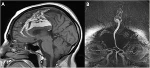 A) Non-contrast T1-weighted MRI sequence. The lesion shows hyperintensity compatible with fatty content; agenesis of the splenium of the corpus callosum and prominent venous drainage are also observed. B) Brain MRI angiography revealing a single arterial trunk distal to the anterior communicating artery, which is compatible with azygos anterior cerebral artery.