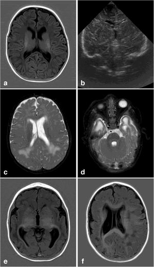 Neuroimaging findings corresponding to the stages of the modified Noyola classification; (a and b) axial slices from T1-weighted brain MRI and transfontanellar ultrasound studies of a 43-day-old patient, scoring 1 on the classification. It shows the presence of a 6-mm germinolytic cyst in the left caudothalamic groove, as well as mild ventriculomegaly of the left lateral ventricle; (c and d) axial slices from T2-weighted brain MRI of a 2-month-old patient, with lesions scoring 2. Multicystic encephalopathy; (e) axial slice from a T1-weighted brain MRI scan of a 4-month-old patient, with a lesion scoring 3. Extensive loss of cortico-subcortical differentiation of the cortical perisylvian grey matter. Hypoplasia of the corpus callosum. Anomalies of neuronal migration and/or band heterotopia. Increased signal in the subcortical white matter of both temporal poles due to gliosis or malacia. Ventricles in the higher threshold of normality; (f) axial slice from a brain MRI FLAIR sequence of a 6-month-old patient, with a lesion scoring 3. Patchy signal in the white matter of both hemispheres and hemispheric asymmetry, with the right hemisphere being smaller in size and showing associated ventriculomegaly. Loss of cortico-subcortical differentiation and increased sulcation, compatible with polymicrogyria.