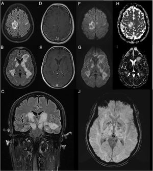 Contrast-enhanced brain MRI (A-B and D-J: axial plane; C: coronal plane). Multiple parenchymal pseudonodular lesions in both hemispheres, hyperintense on FLAIR sequences (A-C), mainly affecting the periventricular and juxtacortical white matter of the right precentral gyrus, the basal ganglia, and the internal capsule, extending caudally to the cerebral peduncles in the midbrain. The lesions are not associated with significant oedema or mass effect. Some present mild open-ring contrast uptake following gadolinium administration (D-E), with mild diffusion restriction (diffusion-weighted imaging: F-G; apparent diffusion coefficient: H-I). Deeper lesions present petechial foci on susceptibility-weighted imaging sequences (J).