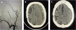 Representative case of an elderly patient with a high comorbidity index (Charlson index > 2, previous history of infarction of the middle cerebral artery), and risk of anaesthesia complications. A) The patient underwent coil embolisation of the middle meningeal artery and polyvinyl alcohol embolisation of the distal branches (arrow). B) Preoperative CT scan after surgical treatment failure showing a subdural haematoma measuring 20 mm, mass effect, and significant midline shift (> 5 mm) (asterisk). C) CT findings at 4 weeks after endovascular treatment, showing complete resolution of the haematoma. The patient was able to resume his previous functional activity (score of 2 on the modified Rankin Scale).