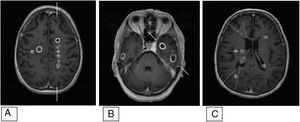 Brain MRI. Contrast-enhanced T1-weighted volumetric sequences conducted for neuronavigation. Axial plane. Abscesses are distributed in watershed territories. A) Between the left MCA (lateral to marks) and the left ACA (medial to marks). B) Between the left MCA (rostral to marks) and the left PCA (caudal to marks). C) Anterior and posterior watershed territories (lines) and in the area of the perforating branches of the right MCA (arrow). Images based on the vascular territories described by Tatu et al.9 and watershed territories described by Caplan.10 ACA: anterior cerebral artery; MCA: middle cerebral artery; PCA: posterior cerebral artery.