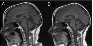 Sagittal slice from a T1-weighted brain MRI sequence performed at symptom onset (A) and at 3 years of progression (B). A) Cerebellar atrophy is observed, predominantly in the vermis. B) Increased cerebellar atrophy and mild prominence of cerebral sulci, predominantly in the perisylvian region.