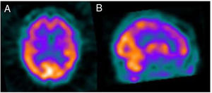 Transaxial (A) and sagittal (B) slices from a brain 99mTc-HMPAO SPECT study. Bilateral frontal hypoperfusion is observed, as well as left frontal and parietal hypoperfusion, compatible with a pattern of frontotemporal dementia.