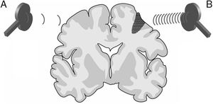 Representation of a coronal section of the human brain. Types of rTMS for promoting neuroplasticity. (A) Low-frequency rTMS (≤1Hz) of the unaffected hemisphere, in the area contralateral to a subcortical lesion (darker area with horizontal lines), reduces inhibition in the damaged hemisphere. (B) High-frequency rTMS (≥5Hz) of the affected hemisphere stimulates neural activity and promotes the reorganisation of interneuronal networks. Adapted from Edwardson et al.9