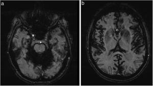 A) Gradient-echo sequences revealed pronounced magnetic susceptibility in the posterior fossa due to diffuse haemosiderin deposition. B) T2-weighted sequences revealed linear hypointensities along the surfaces of the cerebral leptomeninges.