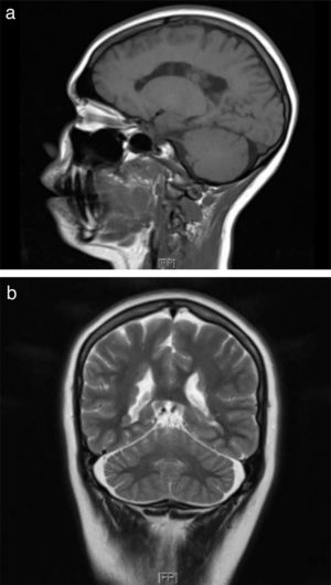 (a) Sagittal T1-weighted sequence (patient’s daughter). (b) Coronal T2-weighted sequence showing a hypointense lesion causing irregularities in the external borders of the lateral ventricles due to PNH (patient’s mother).