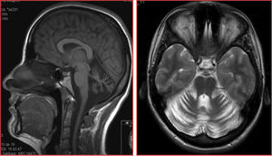 Sagittal T1-weighted and axial T2-weighted MRI sequences from patient 1, revealing diffuse atrophy of the cerebellum, normal morphology of the brainstem, and no white matter lesions.