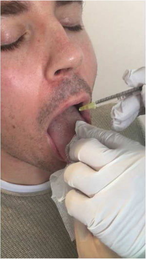 Intraoral injection of BoNT at left genioglossus muscle.