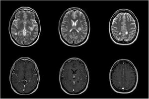 Brain MRI scan performed 48 hours after admission, showing multiple round white matter hyperintensities in both hemispheres, with peripheral contrast uptake.