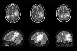 Brain MRI scan performed during treatment with intravenous immunoglobulins, showing radiological worsening despite the patient’s favourable clinical progression. The scan revealed multiple hyperintensities on T2-weighted and FLAIR sequences, with diffusion restriction; the largest lesions involve the left basal ganglia and corticosubcortical regions bilaterally.