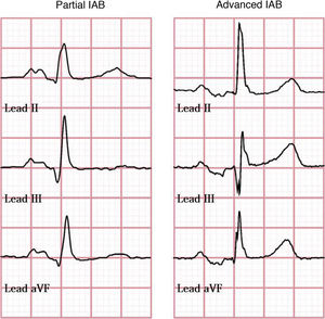 Interatrial blocks (IAB). (A) Partial interatrial block (P-wave > 120ms). (B) Advanced interatrial block (P-wave > 120ms+biphasic morphology in leads II, III, and aVF).