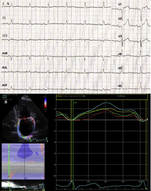 Baseline electrocardiography study. (A) Signs compatible with advanced interatrial block. (B) Left atrial enlargement and decreased peak atrial longitudinal strain.