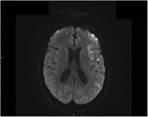 MRI study. Diffusion sequence (axial plane) showing bilateral, predominantly left-sided cortical infarcts.