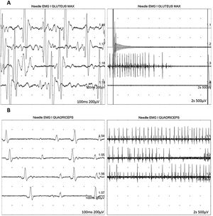Neurophysiological study showing severe, chronic, axonal neurogenic changes in proximal regions of the lower limbs. Electromyography studies of the left gluteus maximus (A) and quadriceps muscles (B) show increased motor unit potential duration and decreased recruitment, indicating loss of motor units.