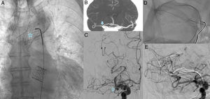 (A) Chest radiography (AP view) performed after implantation of the second prosthetic valve, showing the first bioprosthesis lodged in the aortic arch (star). (B) CT angiography of the circle of Willis (coronal view, maximum intensity projection), showing a filling defect in the M1 segment of the right MCA (arrow). (C) Digital subtraction angiography (AP view), confirming an occlusion in the right MCA (hollow arrow). (D) Fluoroscopy (AP view) showing the Y-configuration double stent retriever technique at the bifurcation of the MCA. (E) Digital subtraction angiography (AP view) performed after the procedure, showing complete recanalisation of the right MCA. AP: anteroposterior; CT: computed tomography; MCA: middle cerebral artery.