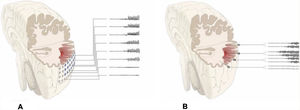 Schematic representation of the onset and propagation of a seizure with intracranial electrodes. A) Seizure recorded with subdural electrodes, which explore the gyral crown and are unable to record activity at deeper levels. Recordings from such a study may give a false localisation, with onset of the discharge being registered simultaneously by several contacts on the subdural grid. B) Seizure recorded with depth electrodes (SEEG). If the working hypothesis for electrode implantation was correct, we may localise seizure onset in a very specific cortical area (in this example, deep within the gyrus), from which activity propagates to other electrodes in a clearly progressive ictal pattern.