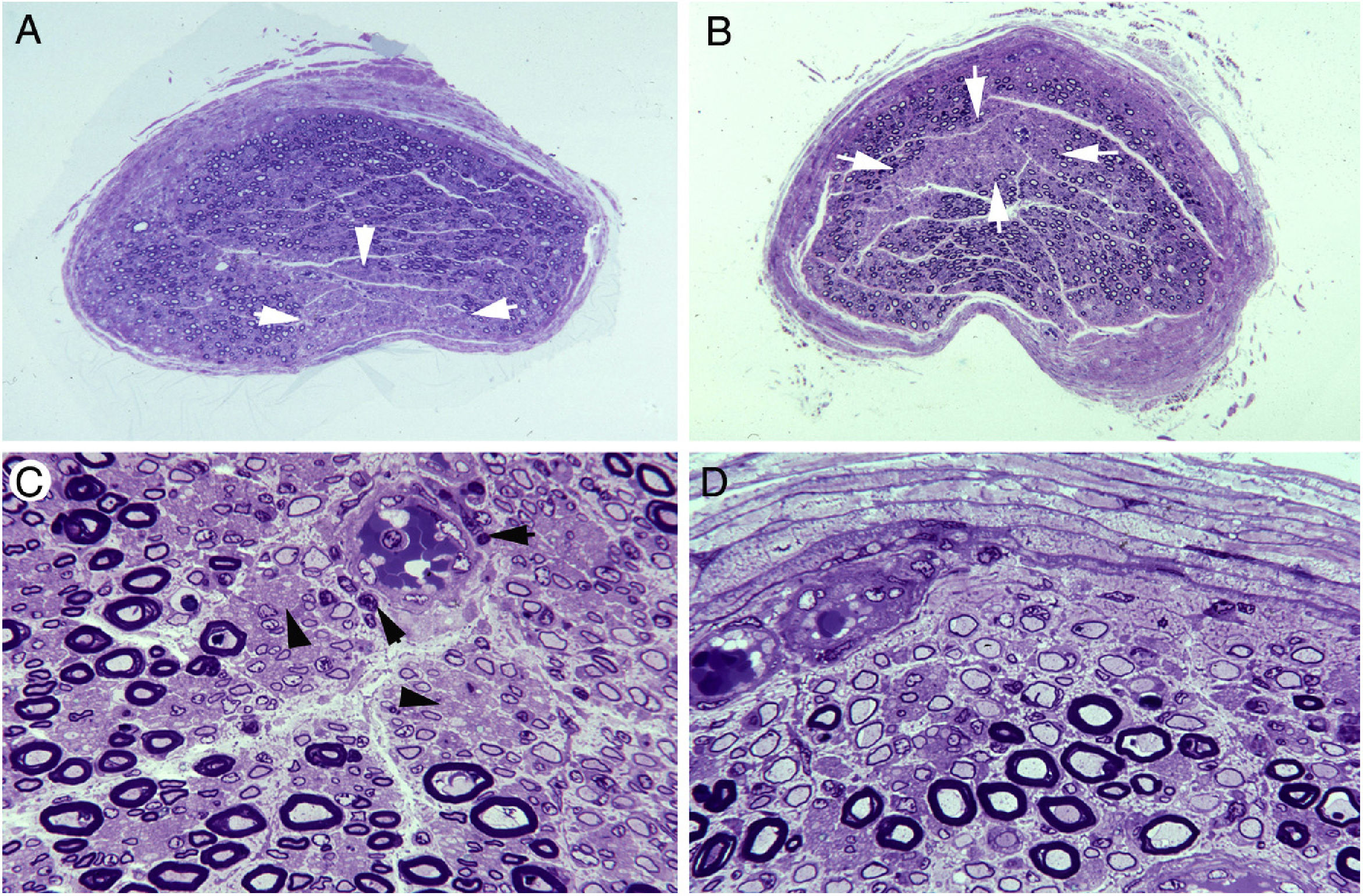Axonal pathology in early stages of Guillain-Barré syndrome ...