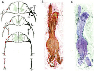 Minimally altered reproduction of figures 65 to 67 from Krücke's12 article. A) Diagram of lesion topography in GBS (from top to bottom: cervical, thoracic, and lumbar regions). Lesions (red dots) are observed in proximal nerve trunks, including the ventral and dorsal spinal roots, spinal ganglia, sympathetic ganglia, and the ventral rami of the spinal nerves. The labels b and c used by the author to signal the localisation of figures 65, 66 (here Fig. 1B and C), and 67 (not reproduced) are maintained. B) Longitudinal section of a nerve segment between the ventral spinal root and the spinal nerve, taken from a patient with GBS who died on the 18th day of progression. The original numbering is maintained. 1 and 2: areas illustrated by Krücke in other figures, demonstrating extensive “mucoid endoneurial oedema” (inflammatory); 3: spinal nerve rami (the ventral and the dorsal ramus); 4: fusiform dilation of the spinal nerve; 5: spinal ganglion; and 6: ventral spinal root. Van Gieson stain, magnification not specified. C) Another longitudinal section from the same location, showing the purple colouration of the fusiform dilation of the spinal nerve. Cresyl violet stain.