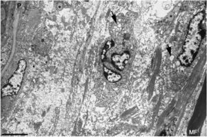 Ultrastructural image of the subperineurial region shown in Fig. 2E. We observe marked endoneurial oedema with amorphous material, probably proteoglycans, and disperse collagen fibril bundles. Note the presence of macrophages containing lipid droplets (asterisks) and numerous endocytic vesicles (arrows) and lysosomes. The oedematous area does not contain myelinated fibres; the only one observed (MF) is situated 20μm from the perineurium (P). Scale bar: 3μm.