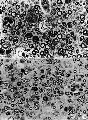 Composition of figure 3 from Berciano et al.38 (A) and figure 2 from Feasby et al.37 (B). Both images show semithin transverse sections of lumbar spinal roots. A) The original annotations are maintained. We observe numerous lipid-laden endoneurial macrophages, sometimes encircling fibres with myelin breakdown (white asterisks) or inside completely destructured nerves. The image also shows clusters of regeneration containing either non-myelinated axons (arrowheads), non-myelinated and thinly myelinated axons (small arrows), and occasional larger fibres with demyelinated or remyelinated axons (large arrows). In the centre of the image is a fibre with vesiculovacuolar dissolution of myelin (black asterisk). This lesion is better documented in figure 6 of Berciano et al.,38 which shows the variety of lesions observed in a teased fibre study. Toluidine blue stain; scale bar: 19μm. B) The caption to the original figure, without annotations, reads: “transverse section showing severe axonal degeneration.” We agree with the authors’ interpretation, as there are indeed numerous axons showing myelin breakdown (white asterisks), which is indicative of acute axonal degeneration.22,39 Note also the presence of fibres with inappropriately thin myelin sheaths (arrowheads) and the fibres exhibiting vacuolar myelin degeneration (black arrows), suggesting de-remyelination; and the clusters of regeneration. Mononuclear inflammatory cells seem to be present in the endoneurial interstitium; the presence of these cells would be better assessed by immunocytochemical techniques.22,39 Although the vesicular dissolution of myelin may have occurred post mortem,40 it was only observed in the lesioned L5 ventral root (and not in the dorsal root, which was spared) in our sample; this supports its morphological value as a sign of demyelination.39 Furthermore, vesicular myelin degeneration is the earliest sign in AIDP, presenting even before the appearance of macrophages in the nerve; this suggests that it is the expression of membrane attack complex formation due to activation of the complement cascade.41 Scale bar: 20μm.Reproduced with permission from Brain.