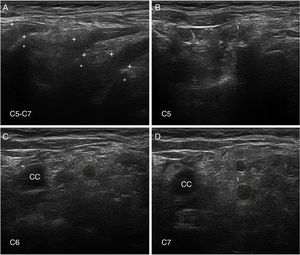 Ultrasound image of cervical nerves from a patient with AIDP (the same patient as Figs. 2 and 3); figures and S1 from Gallardo et al.15 show histology findings from the sixth cervical nerve. A) Sagittal ultrasound image showing blurring of the epineurial covering of all 3 nerves scanned (callipers). The asterisks indicate the transverse processes. B-D) Short-axis ultrasound images of the ventral rami of nerves C5-C7 (dotted green tracings). The nerves show significantly enlarged cross-sectional areas. Note the lack of a hyperechoic epineurial rim; this may be compared against the images published in the normative study by Haun et al.94 The endoneurial inflammatory oedema (see Fig. 2C-D and 3) explains the enlarged cross-sectional area, while the epi-perineurial inflammatory process (see Fig. 2E) would account for the blurring of the hyperechoic epineurial rim.