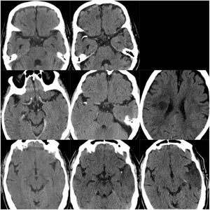 CT scans of CCE in patients 1-3. The first column shows CT scans performed prior to CCE, the second column shows images of the CCE, and the third column shows the image of the corresponding stroke (except for the first patient, for whom the follow-up study after the CCE was not available).