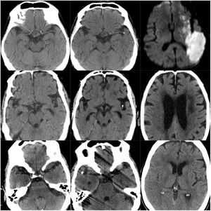 CT scans of CCE in patients 4-6. The first column shows CT scans performed prior to the CCE, the second column shows images of the CCE, and the third column shows images of the stroke in the corresponding territory.